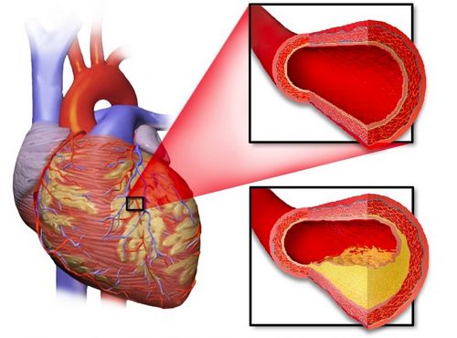 Does Selenium Reduce the Risk of Heart Disease? 