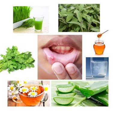 Best Home Remedies for Canker Sores